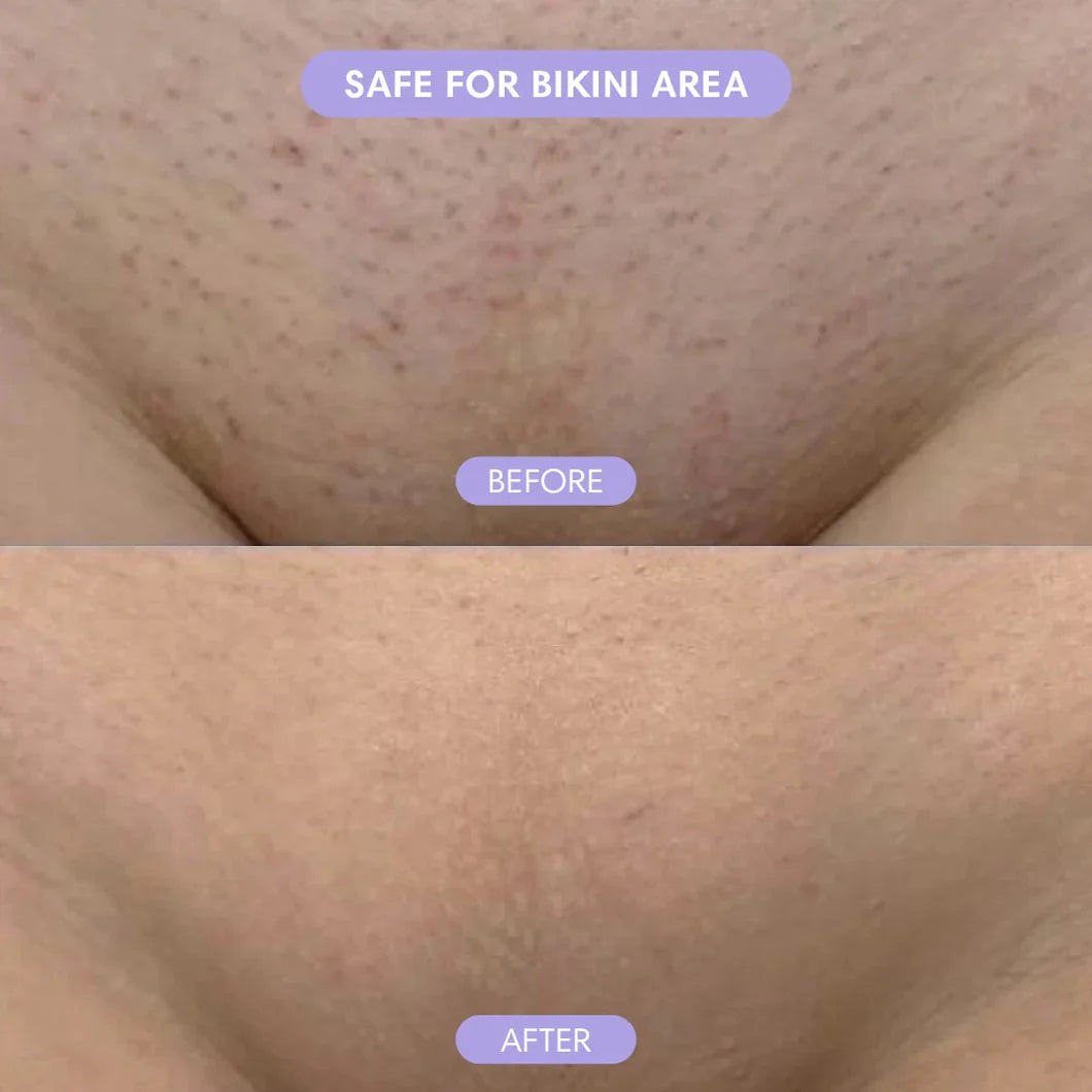 Cloud Sense — Razor-Free, Pain-Free Hair Removal In 10 Minutes